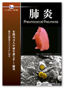 DVD/VHS「肺炎　Pneumococcal Pneumonia」